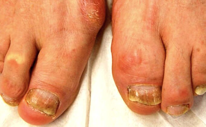 Psoriasis Des Ongles Sur Les Mains Et Les Pieds Causes Diagnostic Et psoriasis-des-ongles-sur-les-mains-et-les-pieds-causes-diagnostic-et